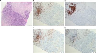 Epstein–Barr Virus+ B Cells in Breast Cancer Immune Response: A Case Report